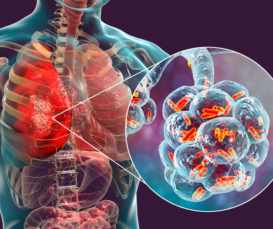 prizadeta pljuča, legioneloza