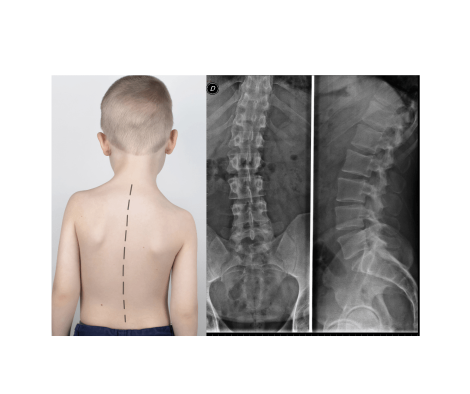 a little boy spine with scoliosis curve