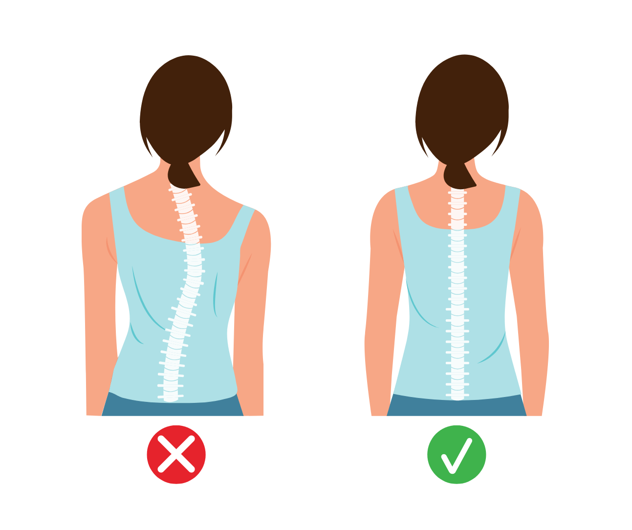 a graphic with two girls spines, one with scoliosis curve