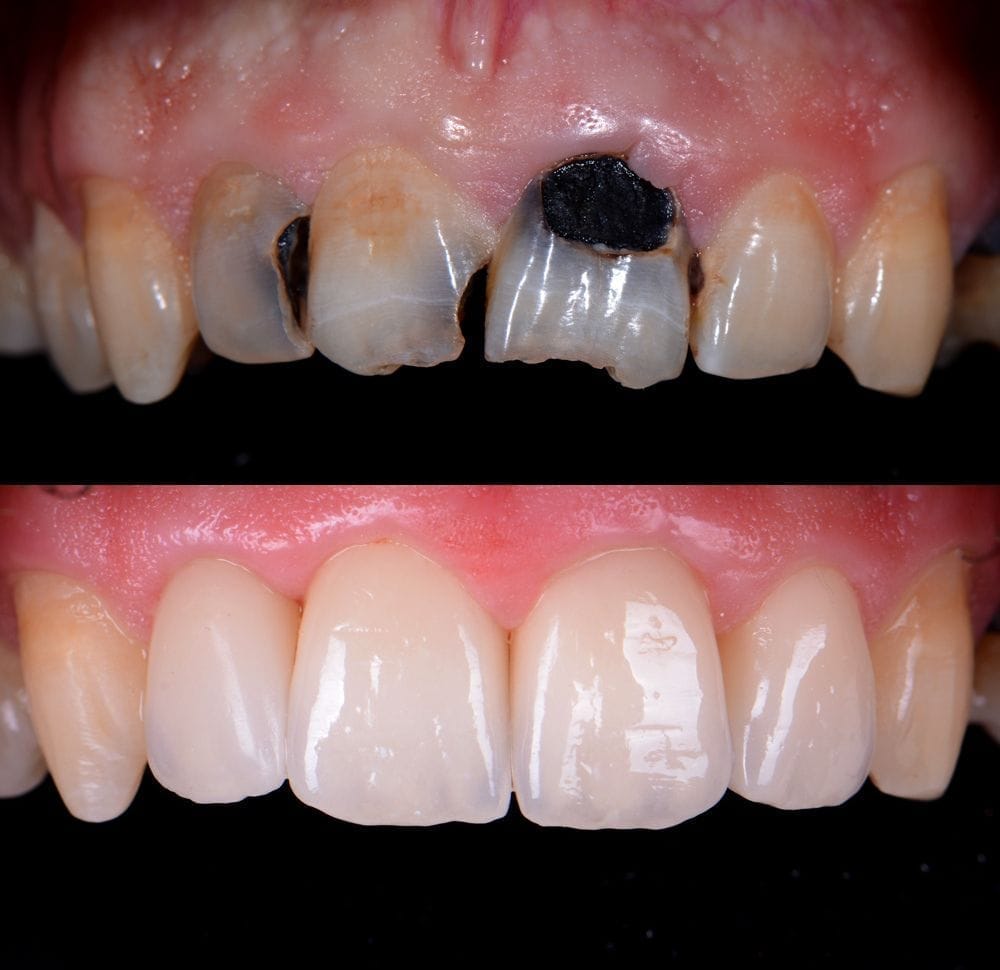 Antes y después — Caries y estética anterior