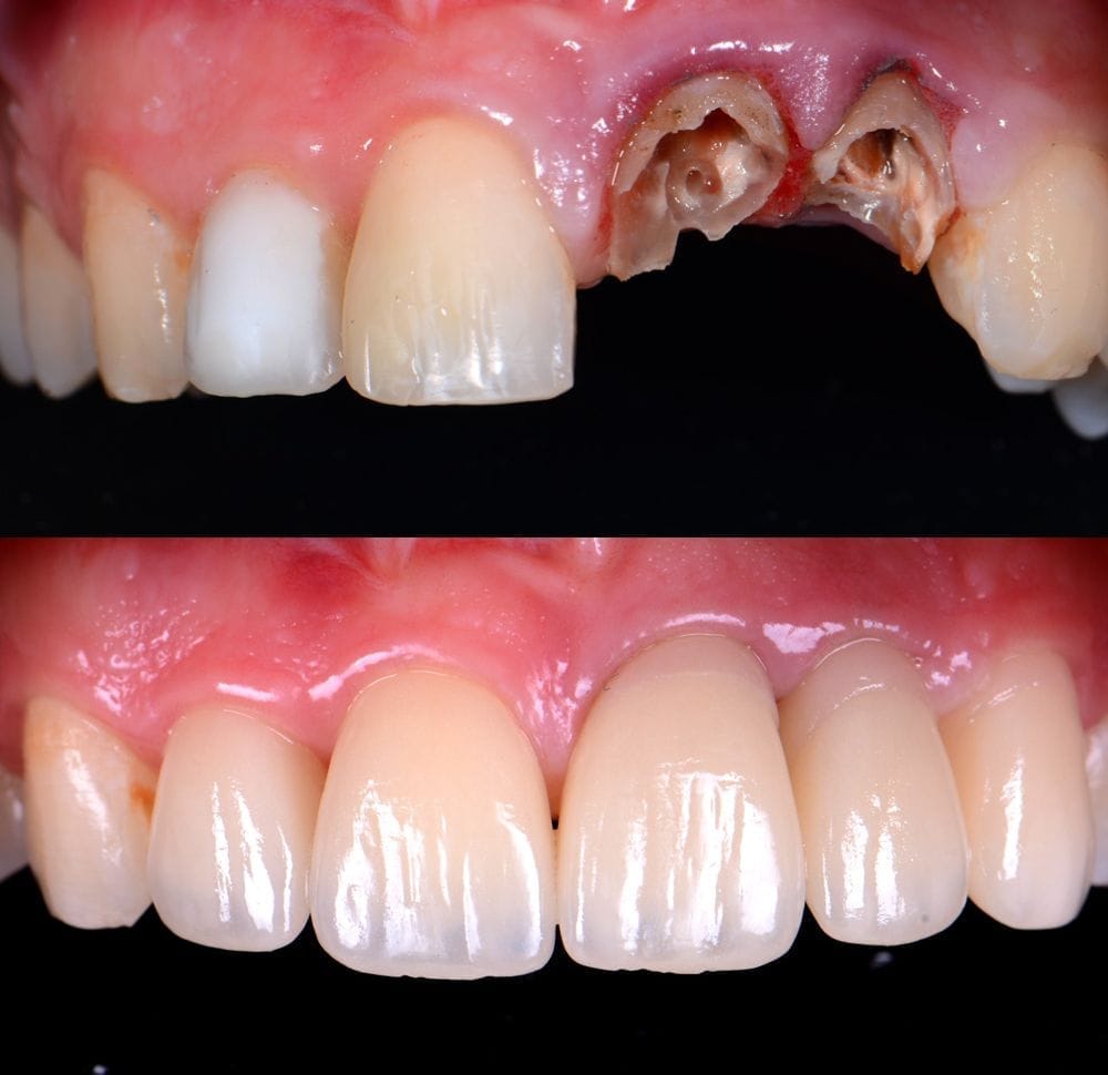 Antes y después — Fractura y coronas