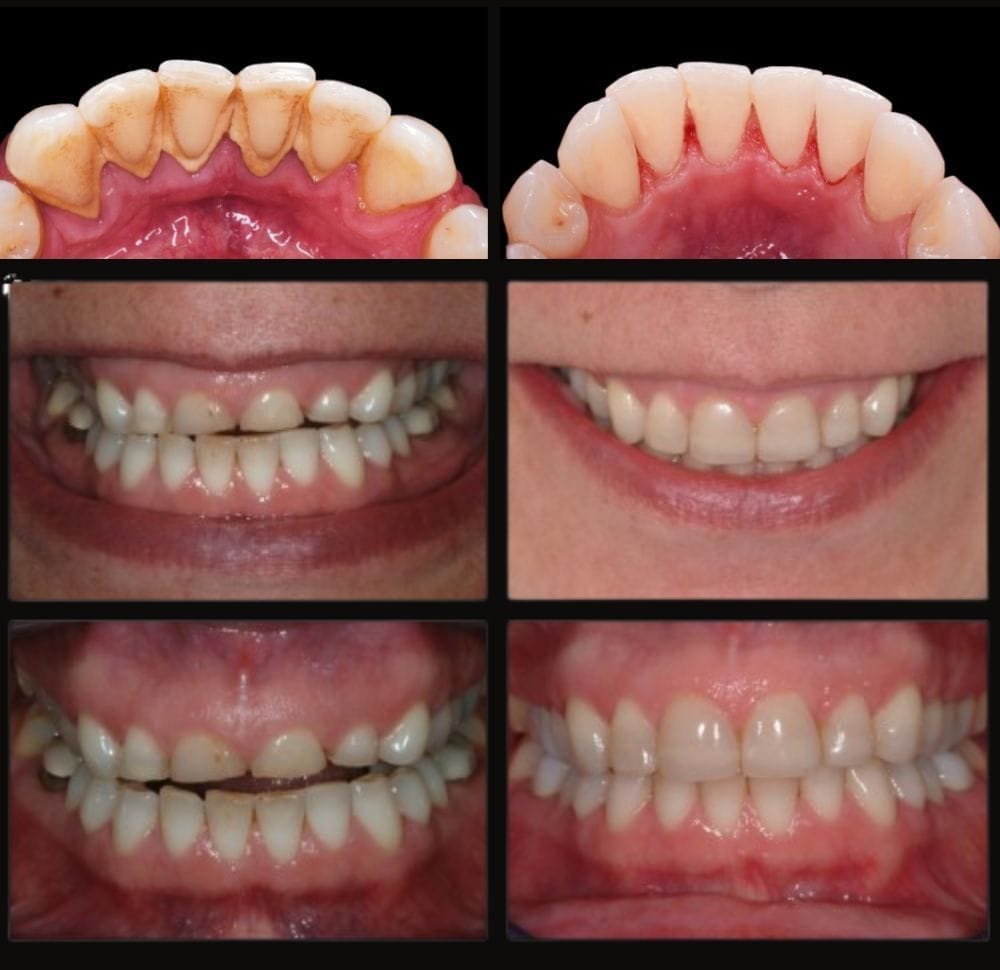 Antes y después — Limpieza y bruxismo