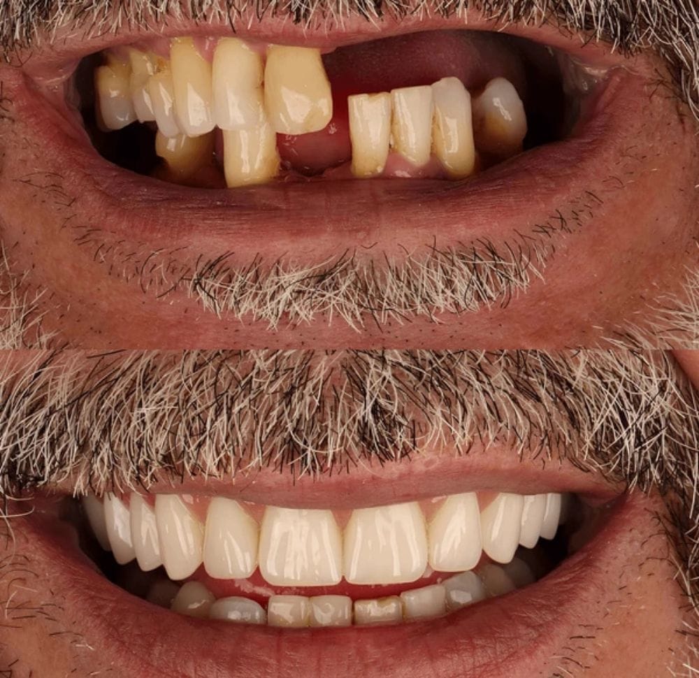 Pérdida dental — antes y después