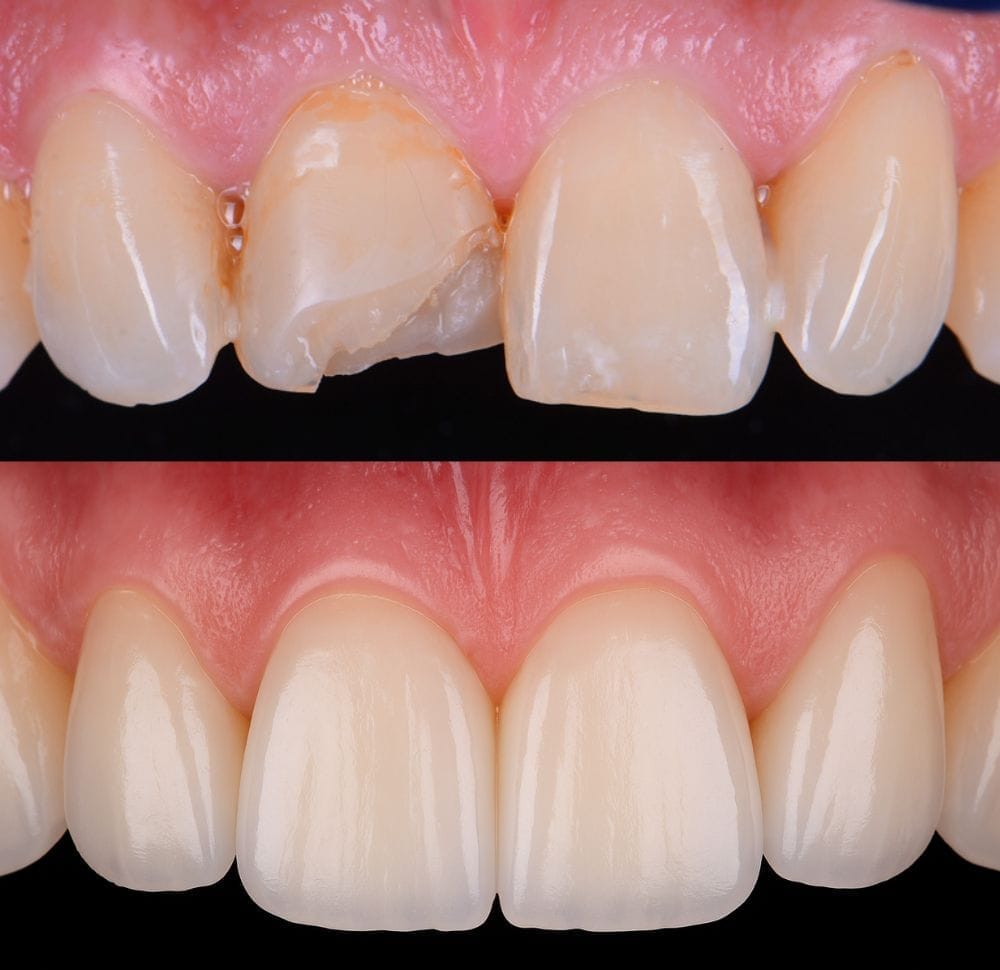 Fractura de borde incisal — antes y después