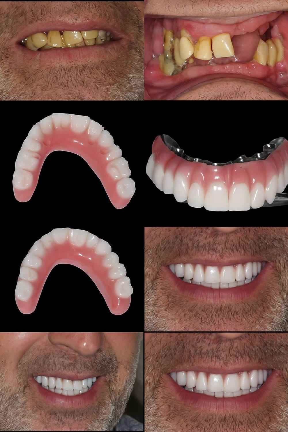 Pérdida dental y rehabilitación completa — antes y después