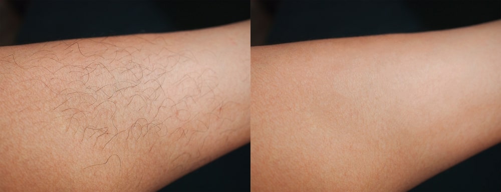 Before & After skin hair removal