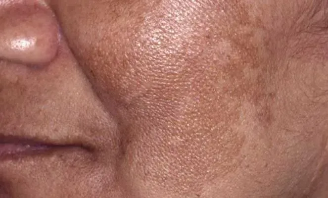 Melasma Facial