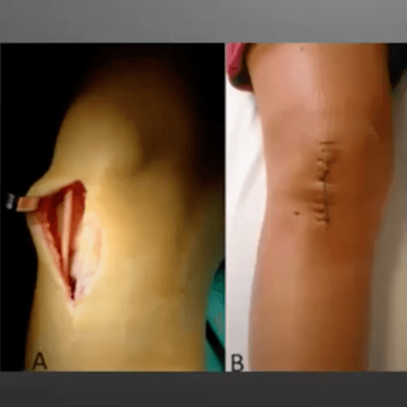 Tipos de injerto de LCA: pros y contras de cada uno