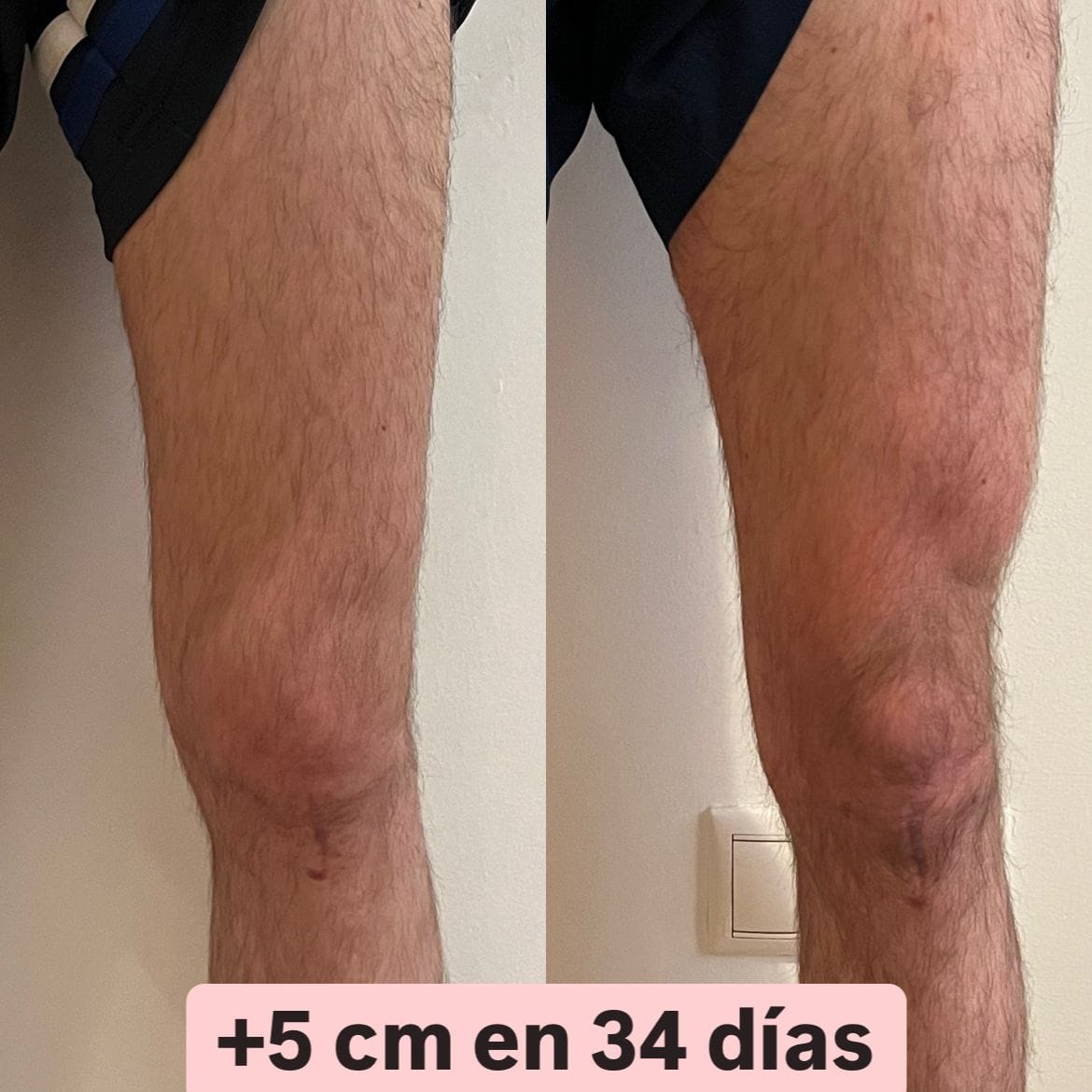 Pierna de flamenco después de la operación de LCA