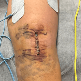 Dolor y molestias durante la rehabilitación de LCA y menisco