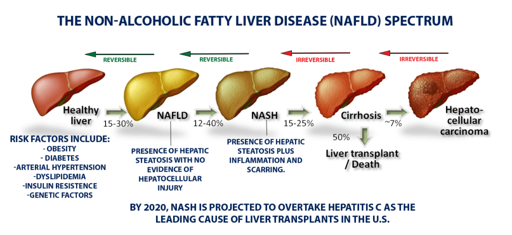 Fatty Liver Disease - Texas Liver Institute