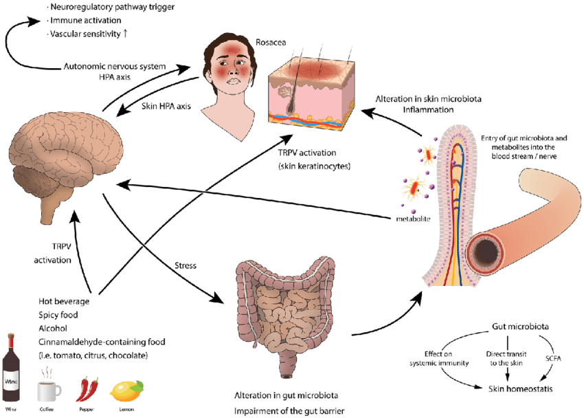 Diagram showingproposed model of the gut-brain-skin axis in rosacea. 