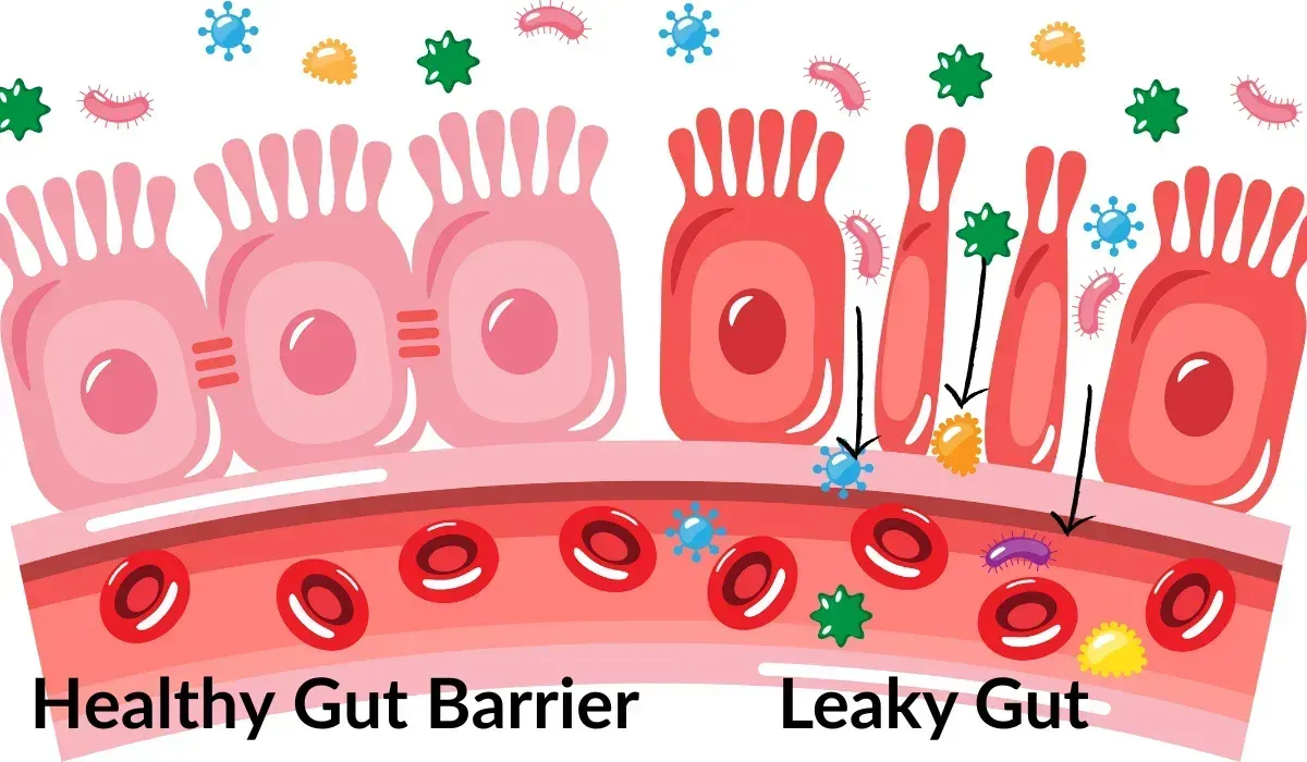 Diagram of leaky gut letting toxins escape into the bloodstream, triggering rosacea inflammation
