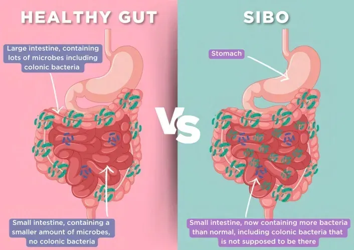 Small intestinal bacterial overgrowth diagram