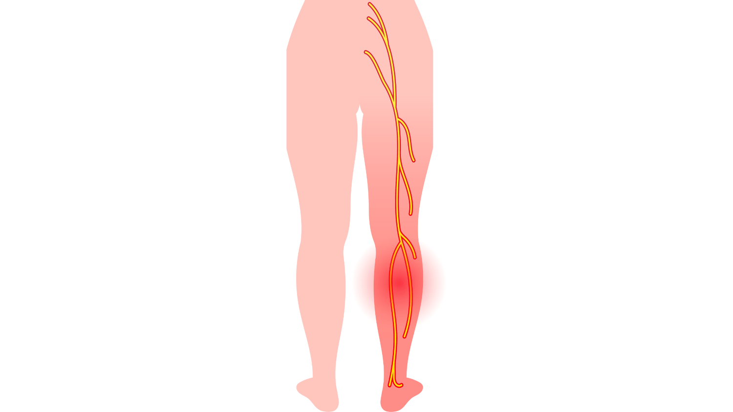 calf pain