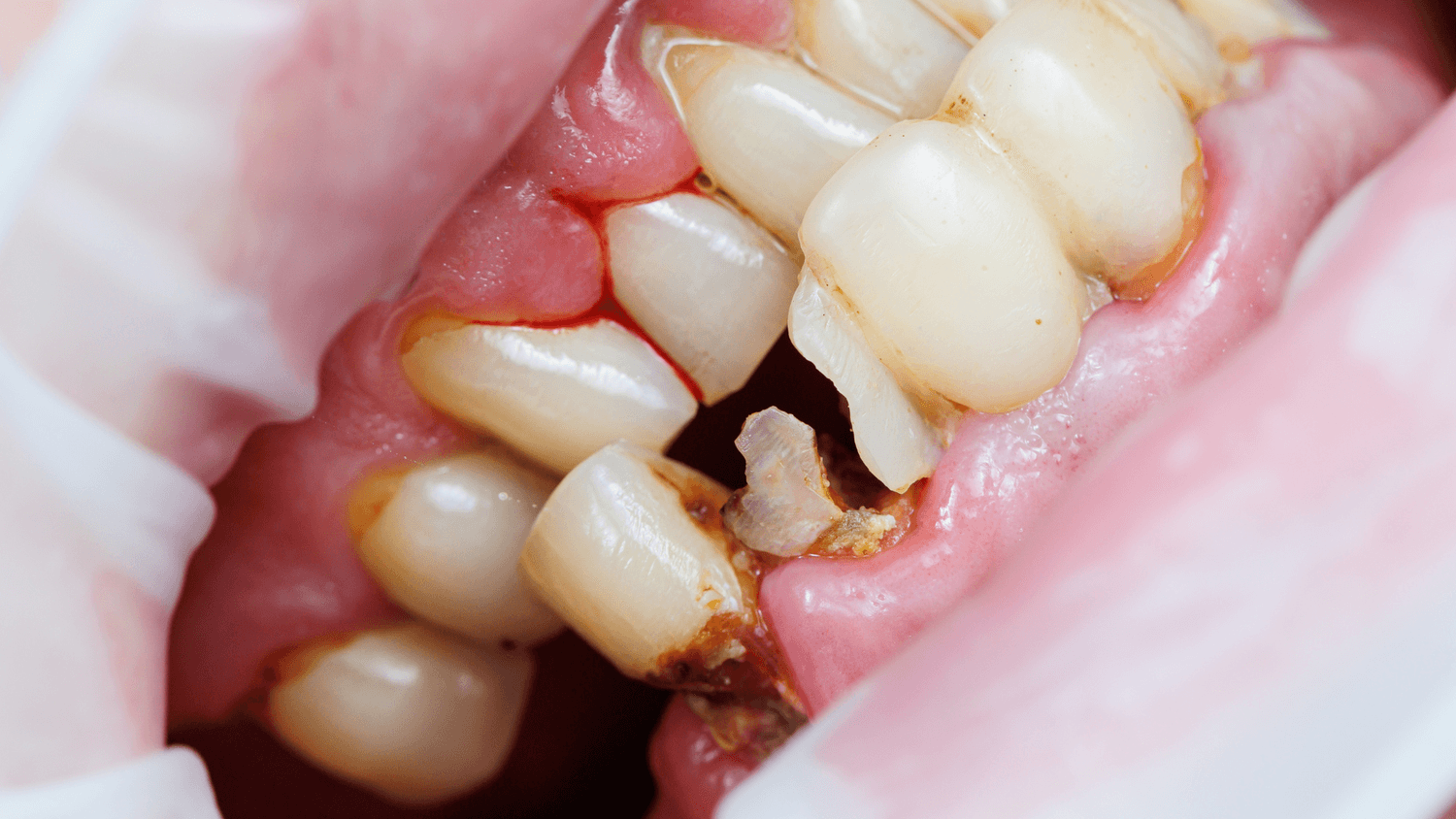 tooth decay