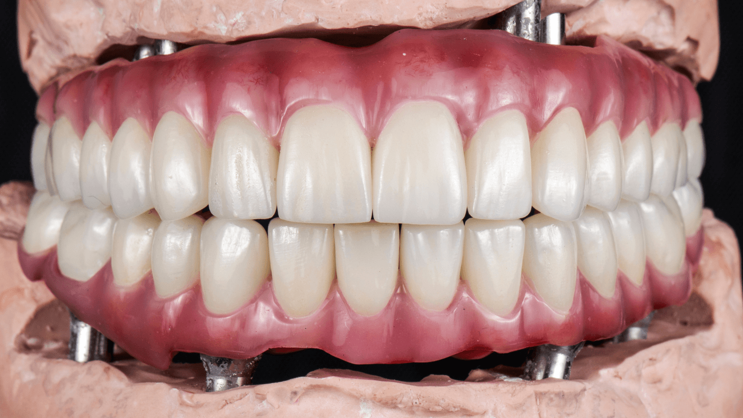full arch dental