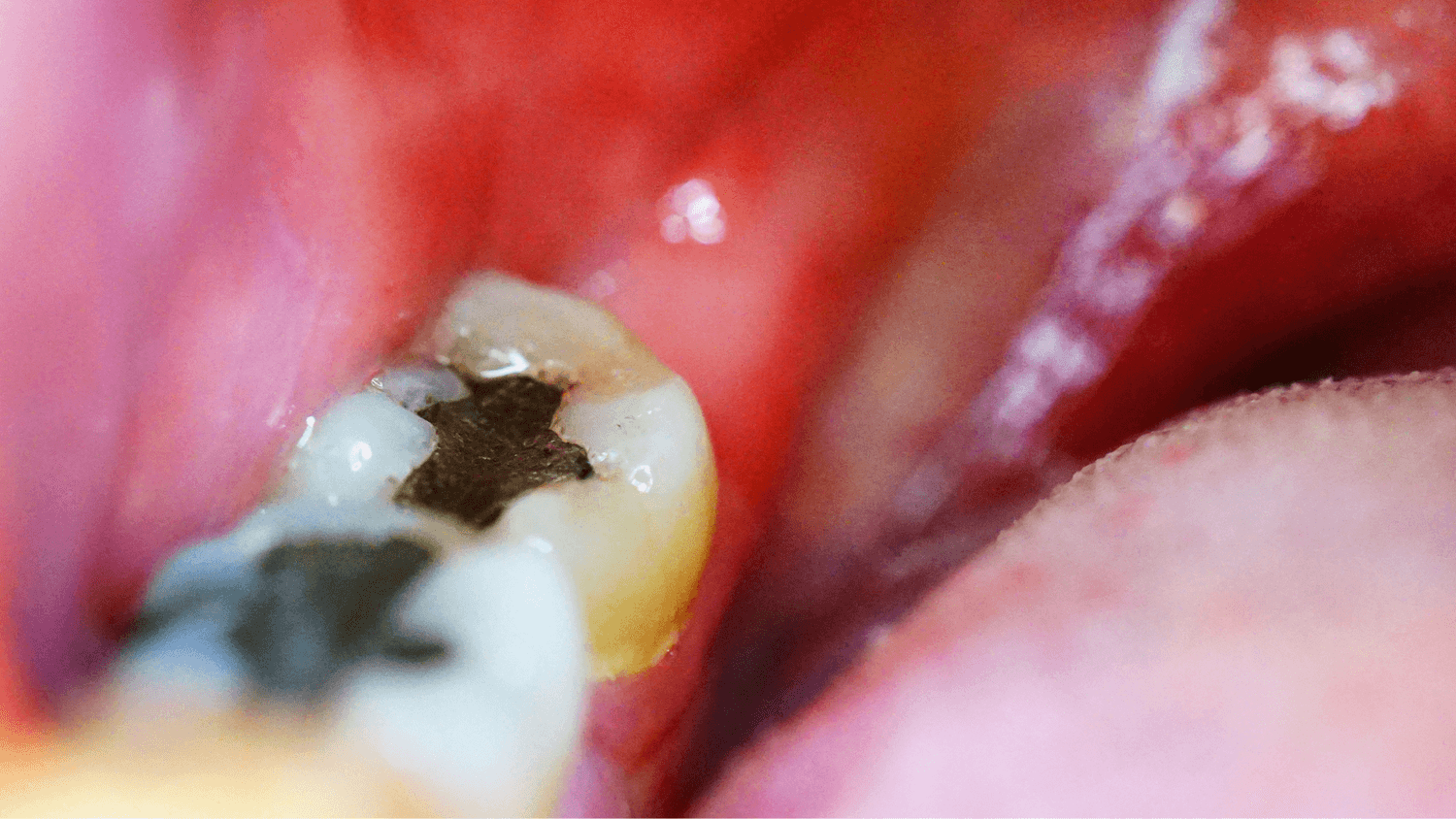 amalgam filling