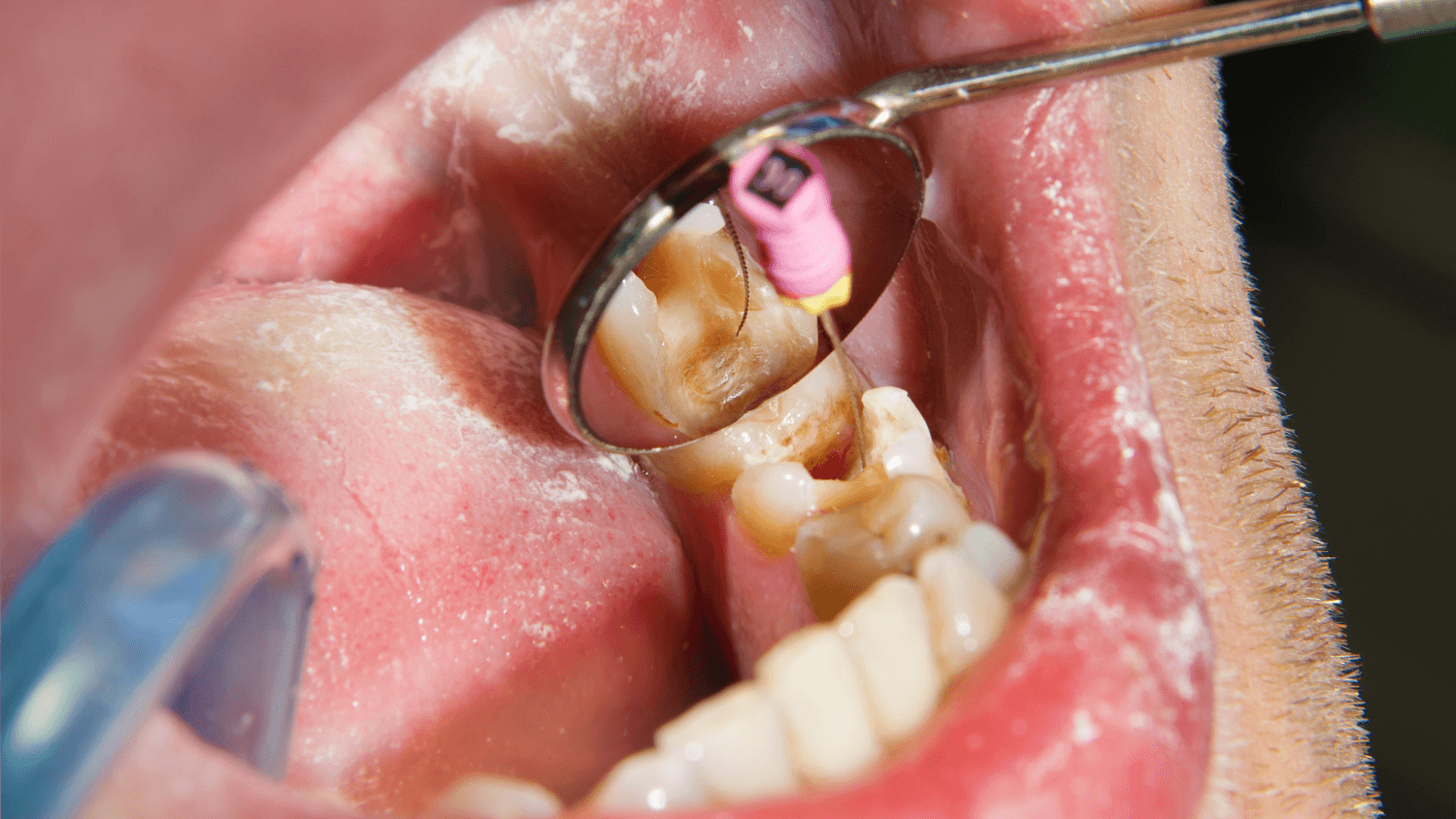clean tooth for filling