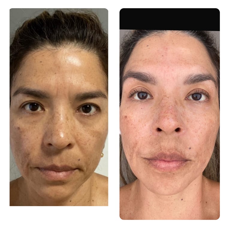 Resultado antes y después