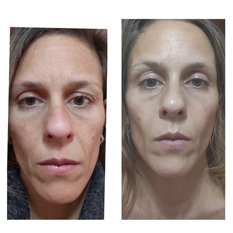 Resultado antes y después