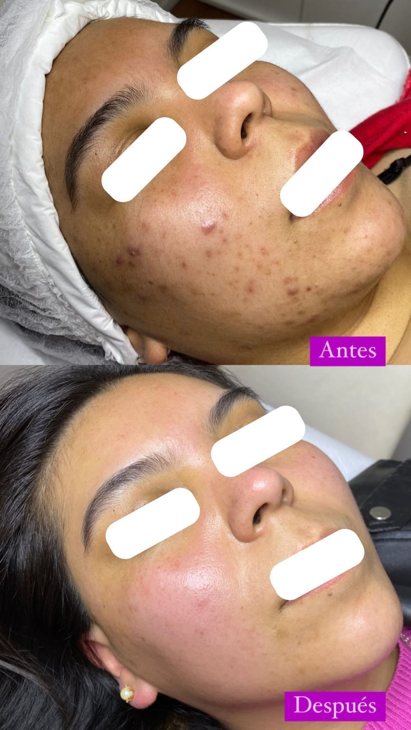 Antes y después