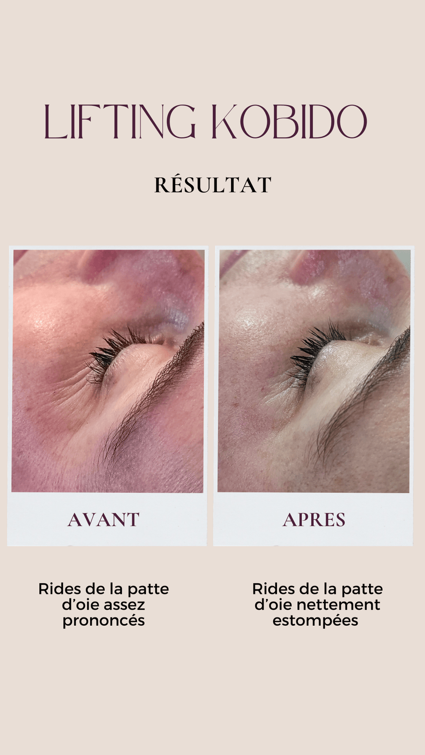 résultat avant après lifting kobido rides