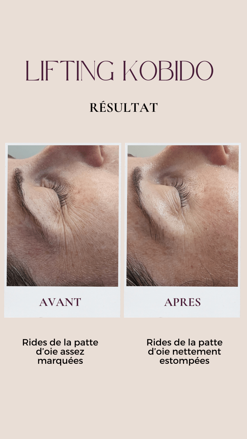 avant après kobido