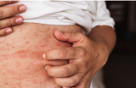 Pediatric rash assessment of a child in Kids Health Journey Clinic with doctor face not visible.